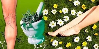 лечение на разширени вени с народни средства