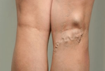 Диагностика на разширени вени при бременни жени