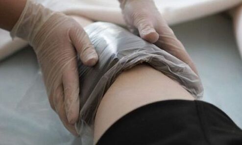 лечение на разширени вени с компреси